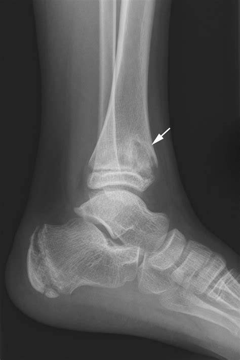 Chronic Recurrent Multifocal Osteomyelitis: Review | AJR