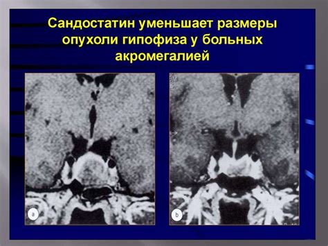 Акромегалия и гигантизм - online presentation