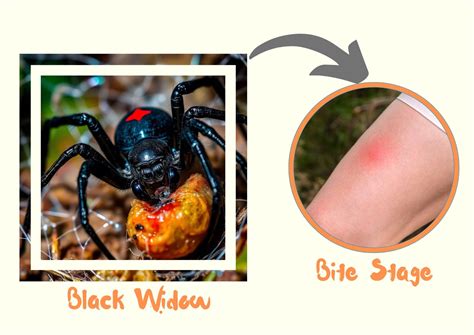 Black Widow Spider Bite Stages, Symptoms with Pictures (Identification)
