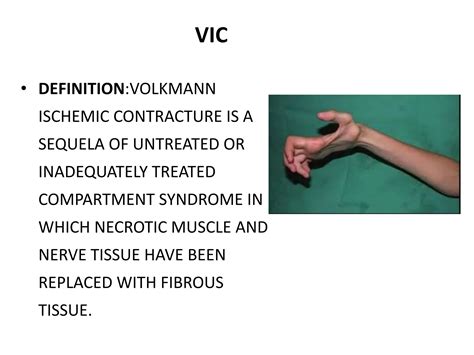 VOLKMANN ISCHEMIC CONTRACTURE SEMINAR.pptx