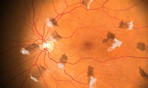 Image result for Eye Floaters Under Microscope