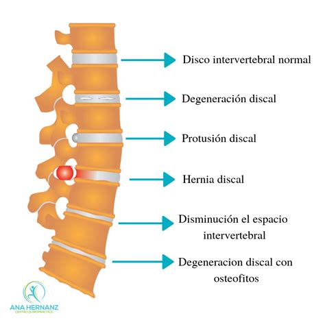 Hernia discal lumbar y tratamiento quiropráctico - Ana Quiropractica ...