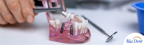 Haident Blog | Full Mouth Dental Implants in Mumbai and its Cost.