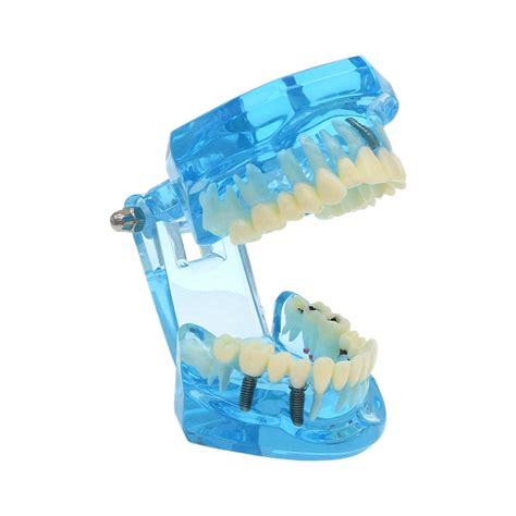Dental Implant Teeth Model Bridge Restoration | Ubuy India