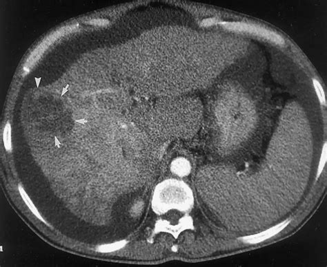 Liver cyst causes, symptoms, diagnosis & treatment