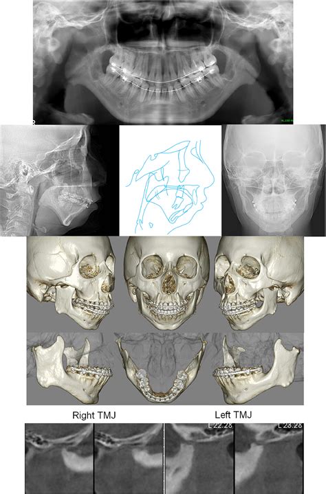 Surgical orthodontic correction of Class II open bite with idiopathic condylar resorption - AJO ...