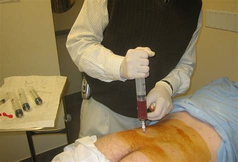 15 Unique Bronchoscopy Procedure Note