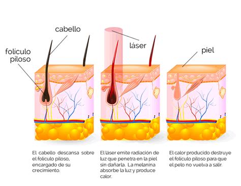 Foliculitis, una indicación para el tratamiento de depilación láser ...
