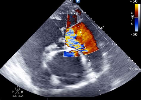 Tricuspid Valve Regurgitation Heart Sound at Hudson Becher blog
