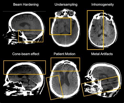 E-160 Detailed evaluation of brain cone-beam CT imaging artifacts: a ...