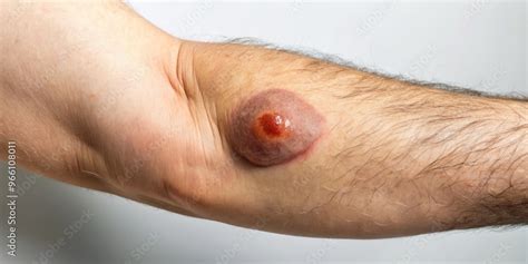 Image result for Elbow Cysts Explode
