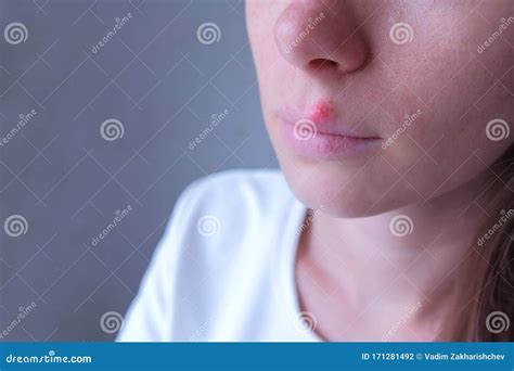 Herpes Virus on Human Lips. Woman with Herpes Sore on Lip Mouth ...