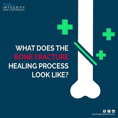 Image result for Bone Healing Process