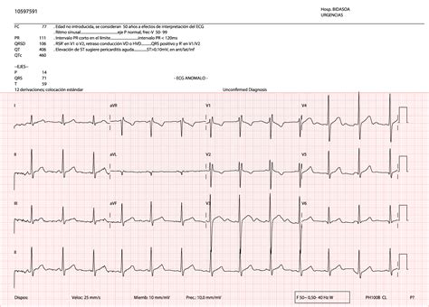 Reflection on the benignity or pathology of the presence of “U waves ...
