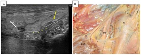 Anatomical Relationships of the Proximal Attachment of the Hamstring ...