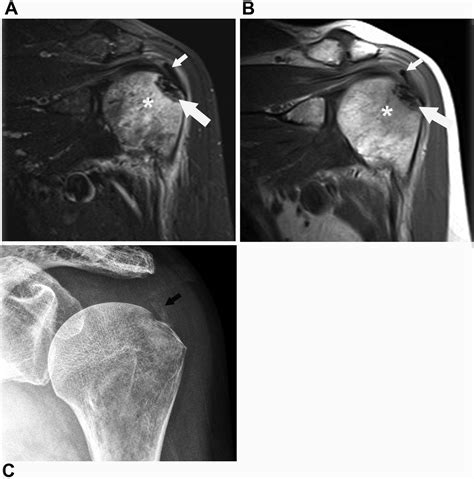 Mimickers of Hill-Sachs Lesions - PMC