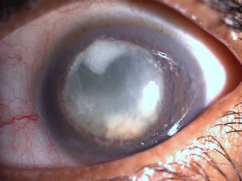 Unit 3- Common Fungal Infections of the Eye | Ocular Microbiology| 3rd ...