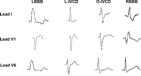 Effect of Left Ventricular Conduction Delay on All-Cause and ...