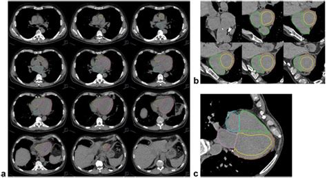Fully Automated Assessment of Cardiac Chamber Volumes and Myocardial ...