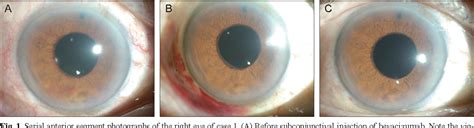 Subconjunctival Injection 的图像结果