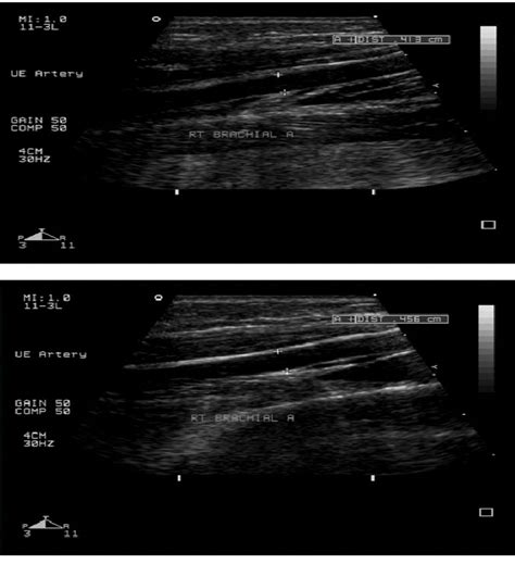Comparison of degree of endothelial dysfunction in diabetic patients ...