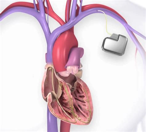 Image result for Installing Pacemaker