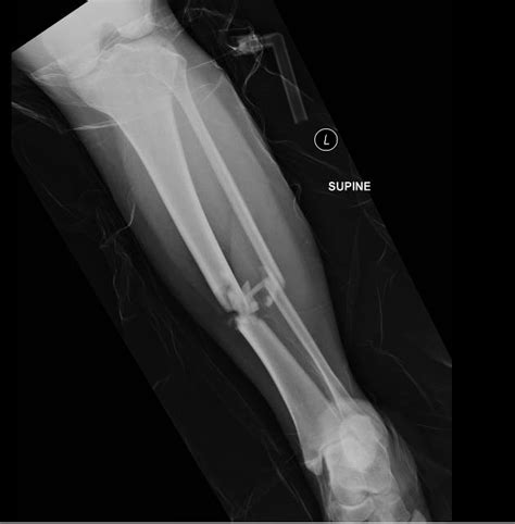 Tibia And Fibula Fracture Surgery
