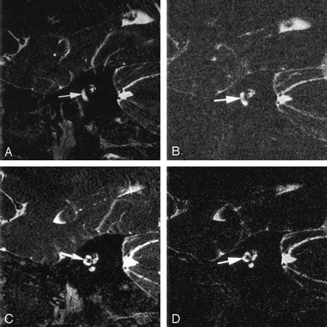 Image result for Modiolus Cochlea
