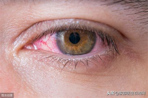 眼睛红肿痒怎么回事呢（眼睛发红是过度疲劳？可能患上这5种疾病，尽早了解） | 说明书网