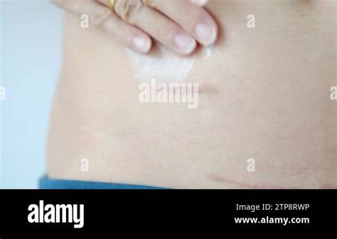 Image result for Appendix Surgery Scar
