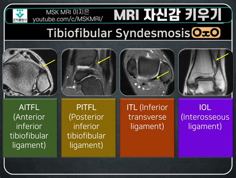 Anterior Tibiofibular Ligament Mri