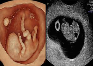 Image result for Fetalscreen II