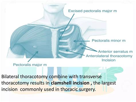 Image result for Exploratory Thoracotomy