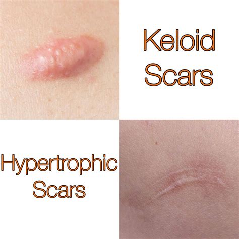 Treat and Prevent Keloids and Hypertrophic Scars