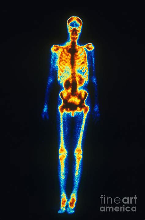 Image result for Normal Bone Scan