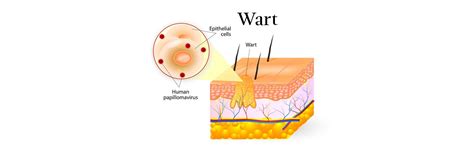 Genital Warts: Signs, Symptoms, Causes & Treatment