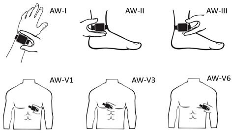 Using a Smartwatch to Record Precordial Electrocardiograms: A ...