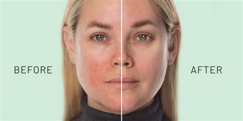 Damaged Skin Barrier: Signs, Causes & Repair Routine (2026) – KLIR