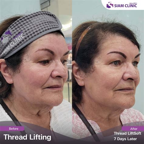 Image result for Thread Removal