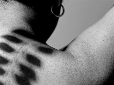 Image result for Soft Tissue Sarcoma Back of Neck