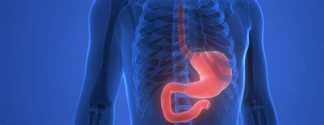 Image result for Linx Gerd Procedure