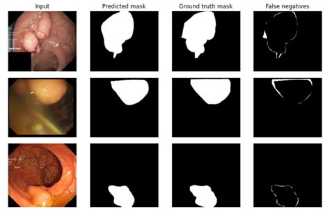 Image result for Polyp Detection Device