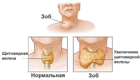 Зоб: узловой, диффузный токсический, эндемический; симптомы, фото