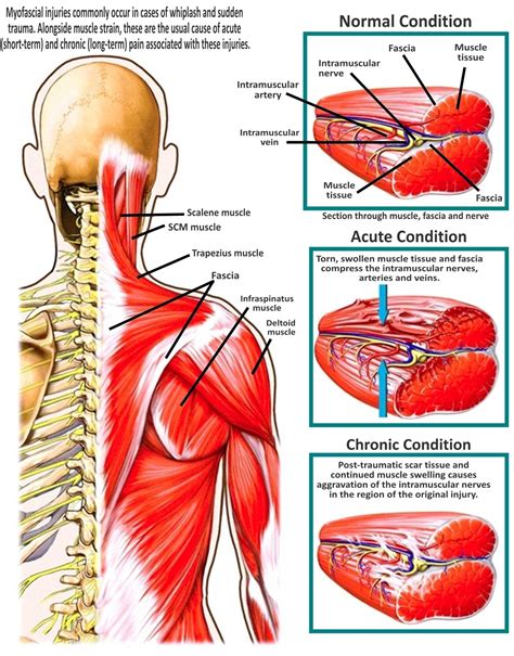 Trapezius Muscle Strain Treatment
