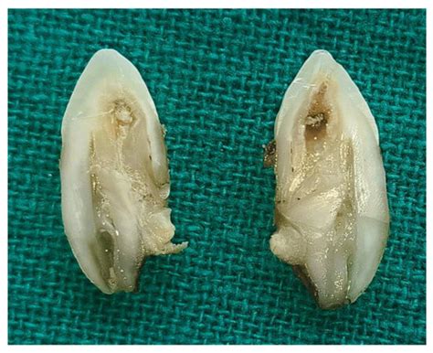 Dilated Composite Odontoma in a Mesiodens