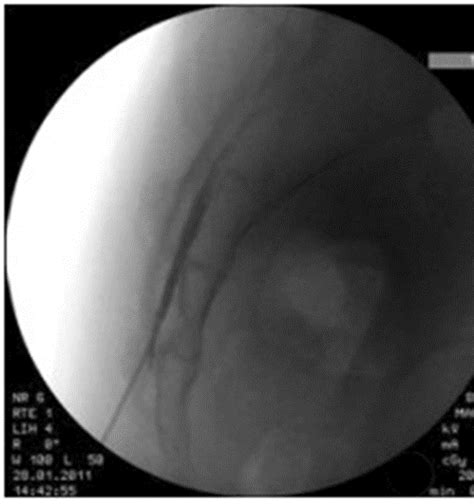 Successful neuraxial blockade under lumbar X-ray guidance in patients ...