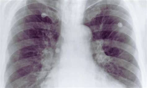 Aortic Calcification on Chest X-Ray Signals Poorer Survival After Minor ...