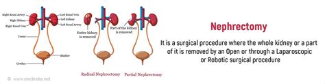 Image result for Open Nephrectomy Procedure