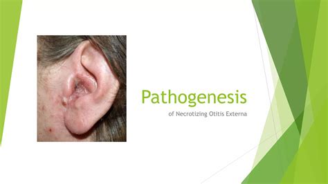 Necrotizing Otitis Externa | PPTX