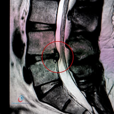 Herniated Disc L4 L5